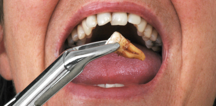 Importance of Understanding Dietary Restrictions After Tooth Extraction